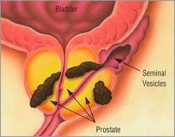 prostate_2